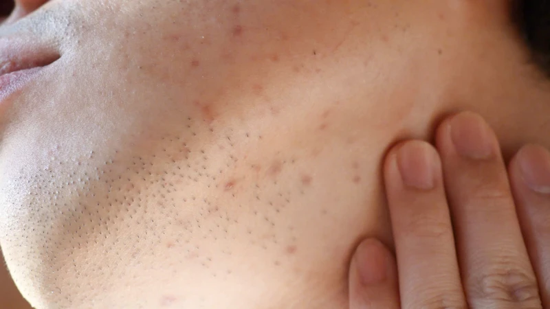 Nọng cằm có thể xuất hiện do nhiều yếu tố liên quan đến cơ địa và lối sống