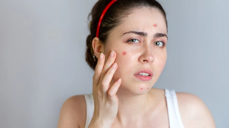 Nóng gan nổi mụn nên uống gì? Nguyên nhân khiến gan bị nóng và dẫn đến nổi mụn?