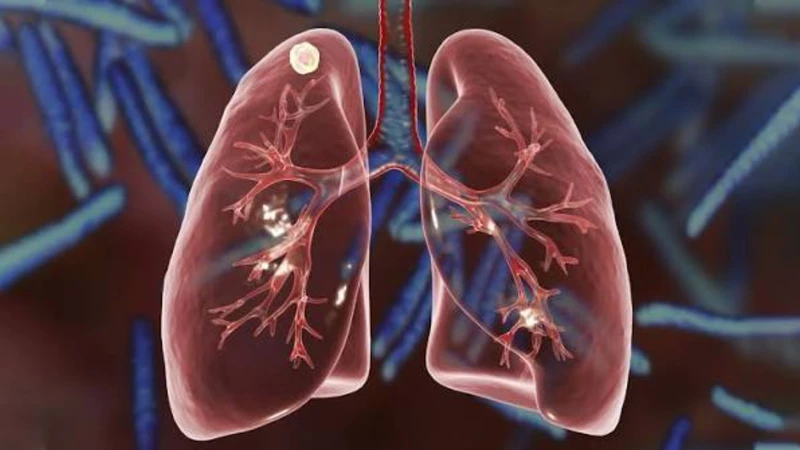Phát hiện nốt phổi thường là tình cờ qua các phương pháp chẩn đoán hình ảnh