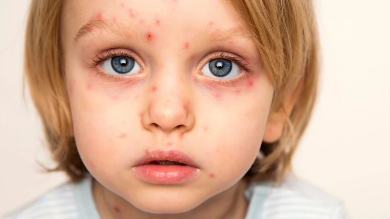 Nốt thủy đậu mới mọc: Cách nhận biết sớm và chăm sóc đúng cách 1