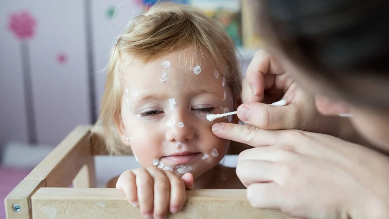 Nốt thủy đậu mới mọc: Cách nhận biết sớm và chăm sóc đúng cách 2
