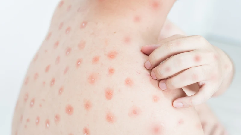 Nốt thủy đậu mưng mủ trắng là dấu hiệu nhiễm trùng da