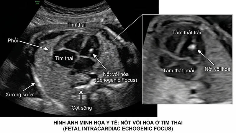 Hình ảnh siêu âm cho thấy nốt vôi hoá ở tim thai