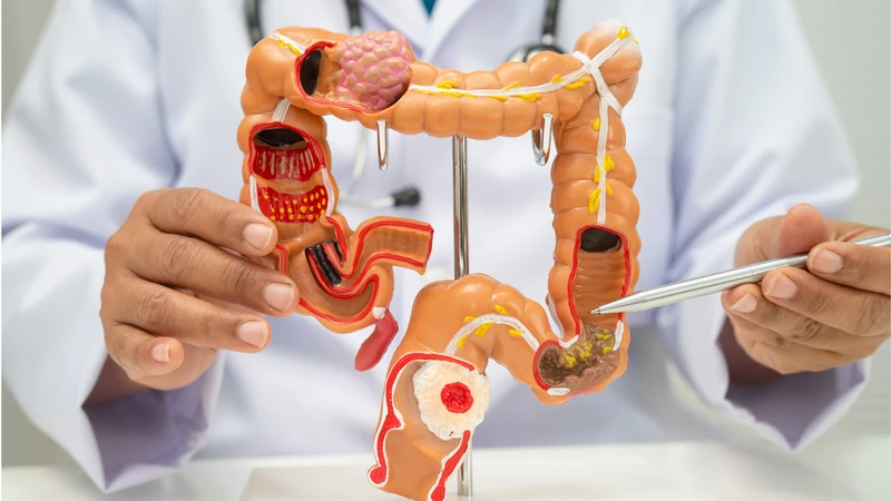 Tắc nghẽn đường ruột là một biến chứng hiếm gặp nhưng cần lưu ý