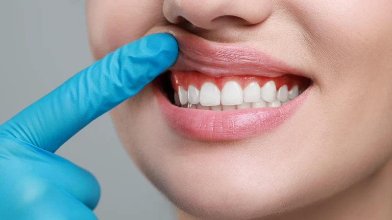 Nướu là gì? Nướu là lớp mô mềm ôm khít quanh chân răng, kéo dài từ khu vực cổ răng đến tận đáy khoang miệng