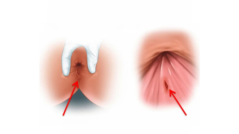 Nứt kẽ hậu môn sau sinh: Nguyên nhân, dấu hiệu và cách cải thiện hiệu quả 2