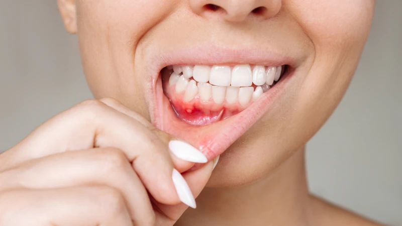 Nút lưỡi có bị nhiễm HIV không là thắc mắc của nhiều người
