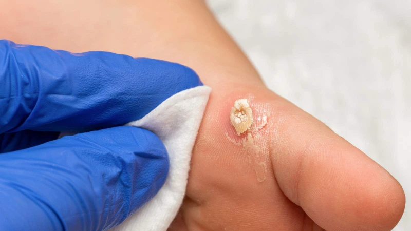 Papilloma thanh quản là gì? Cách phòng ngừa và điều trị 2.jpg
