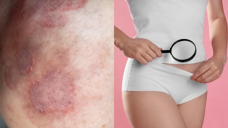 Phân biệt hắc lào và giang mai: Dấu hiệu nhận biết và cách phòng ngừa 1