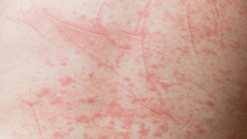 Phân biệt sốt virus và sốt xuất huyết 1