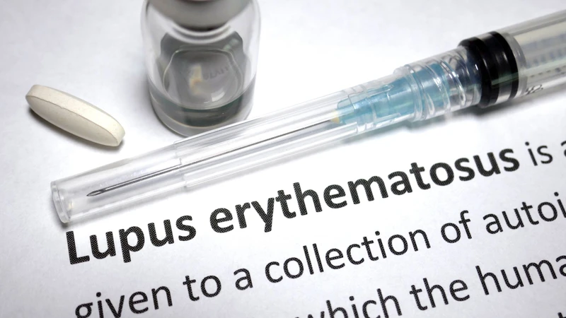 Hiểu tiêu chuẩn chẩn đoán lupus ban đỏ hệ thống giúp phát hiện bệnh sớm