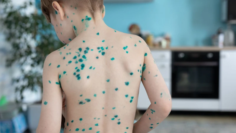 Thủy đậu cần chăm sóc da đúng cách để hạn chế nhiễm trùng và để lại sẹo