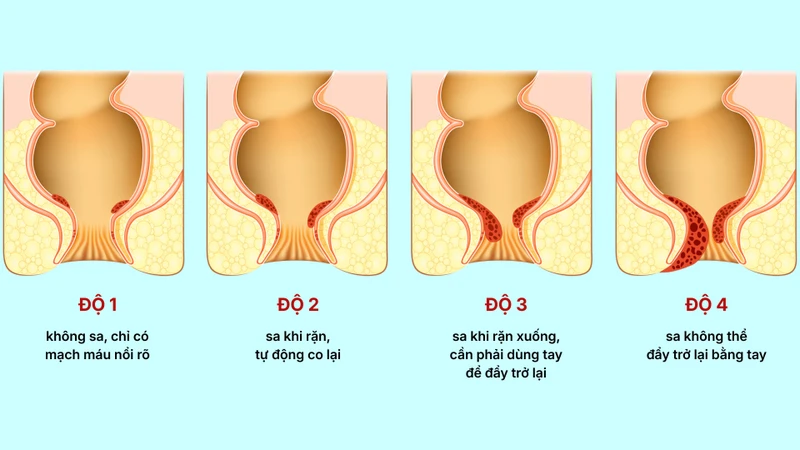 Phân độ trĩ nội theo 4 cấp độ
