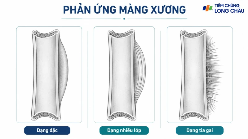 Phản ứng màng xương là sự hình thành xương mới khi màng xương bị kích thích