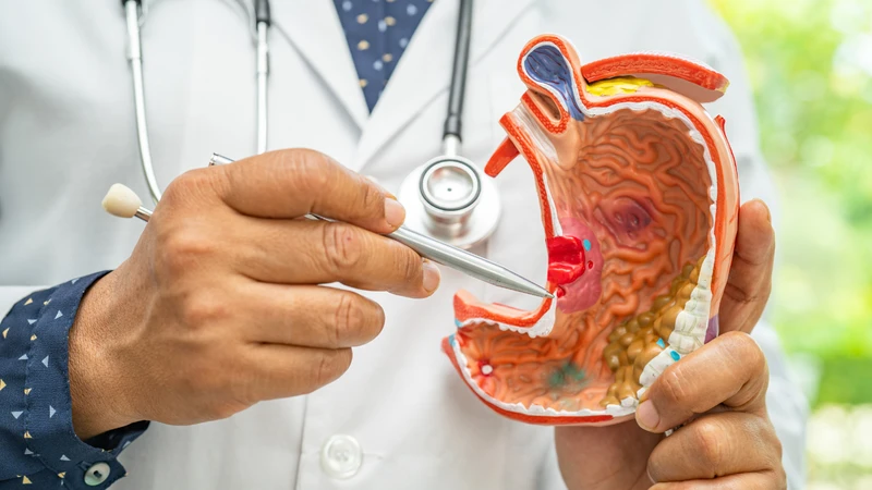 Cách nhận biết sớm dấu hiệu ung thư dạ dày để chữa trị kịp thời 1