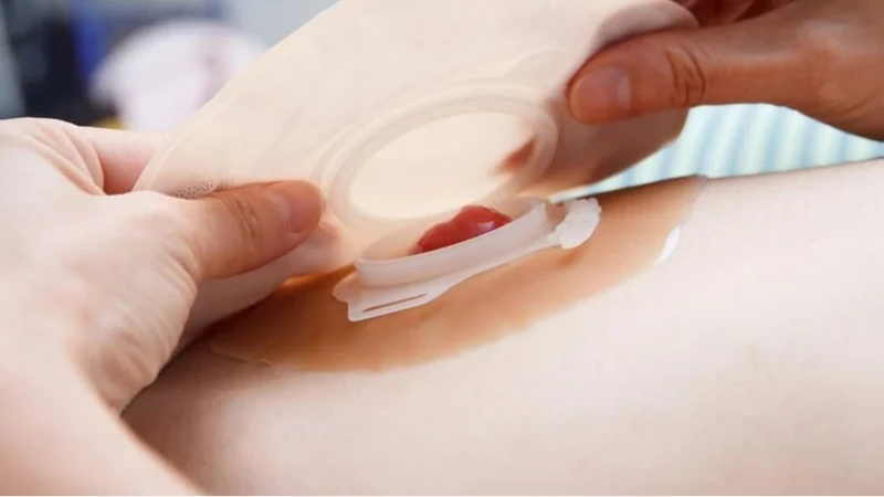 Phẫu thuật đóng hậu môn nhân tạo giúp nối lại đoạn ruột, đóng lỗ mở trên thành bụng