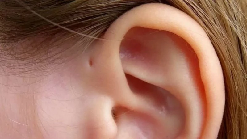 Rò luân nhĩ là dị tật bẩm sinh, thường xuất hiện với lỗ nhỏ bất thường trên vành tai