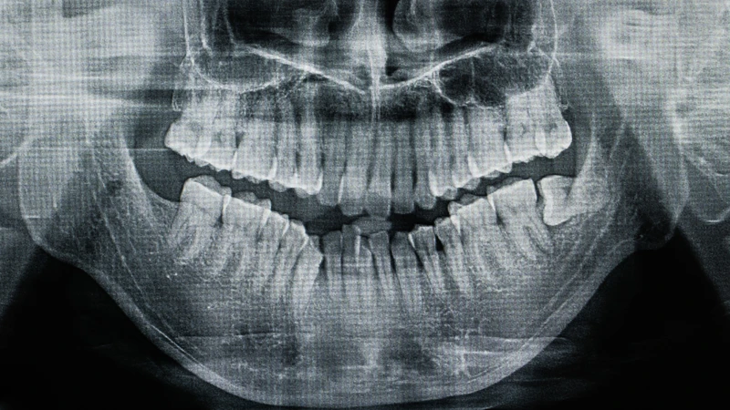 Người bệnh cần thực hiện chụp X-quang để bác sĩ đánh giá cấu trúc xương cằm