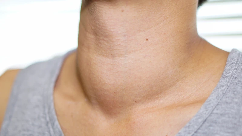 Vùng cổ xuất hiện khối phình hoặc bướu
