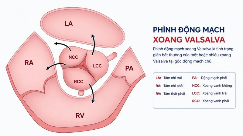 Phình động mạch xoang Valsalva là tình trạng một vùng của thành xoang Valsalva bị giãn hoặc phình bất thường