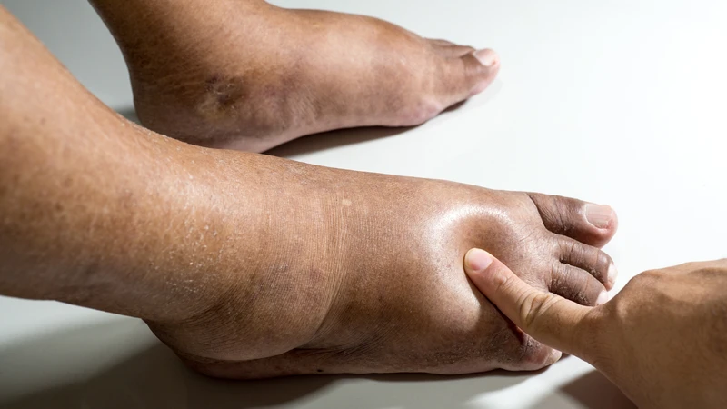Phù chân có nguy hiểm không phụ thuộc vào nguyên nhân