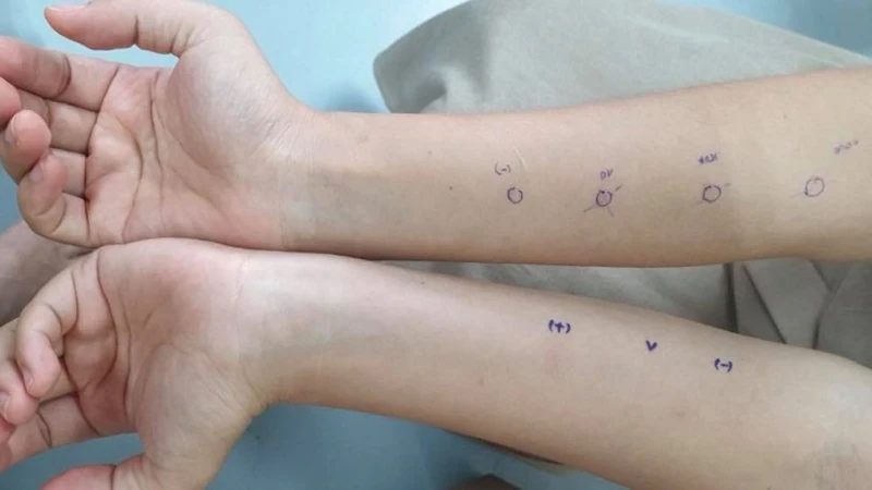 Phù mạch là gì? Cần chú ý gì khi mắc bệnh 5.jpg