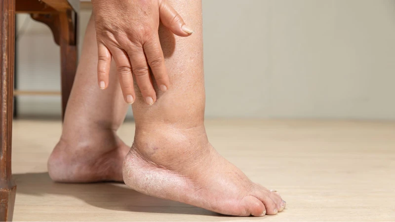 Phù chân khiến người bệnh cảm thấy nặng chân, căng tức và khó di chuyển