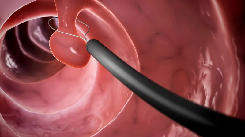 Ở đại tràng,&nbsp;polyp có phải là ung thư không còn tùy thuộc vào tính chất của polyp là lành tính hay ác tính
