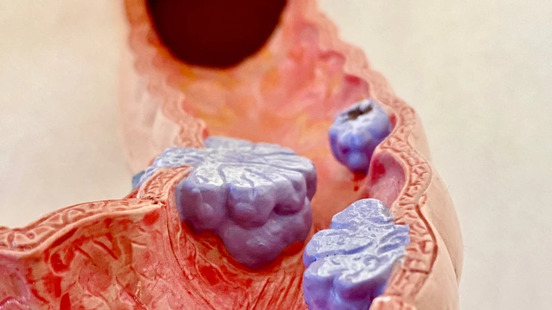 Nếu có nhiều polyp hoặc chảy máu tái diễn, trẻ cần được đánh giá kỹ hơn