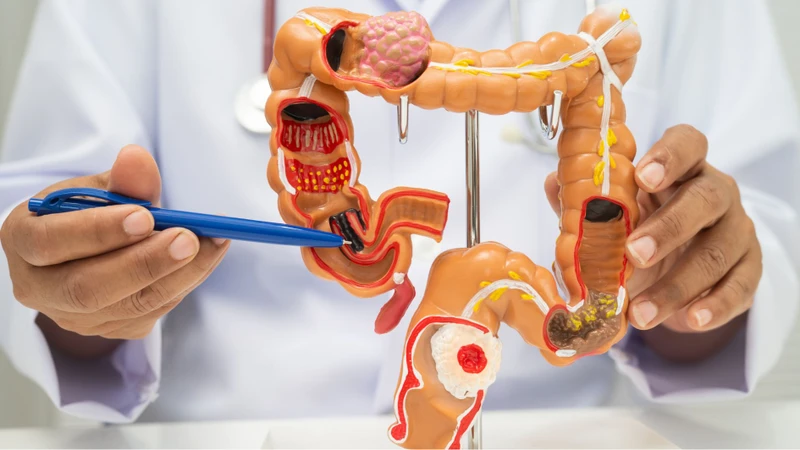 Polyp ống tiêu hóa là gì? Là những khối mô phát triển từ niêm mạc đường tiêu hóa