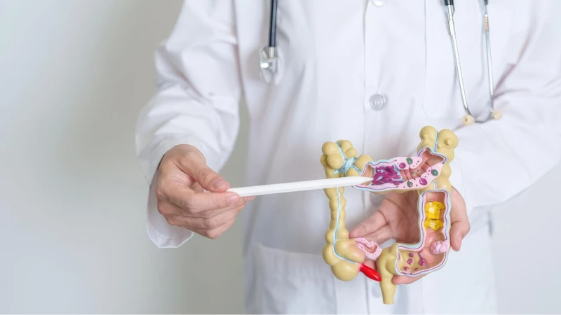 Một số polyp tiền ung thư có thể tiến triển thành ung thư đại trực tràng