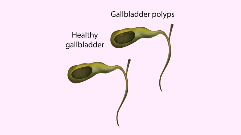 Polyp túi mật 7mm có nguy hiểm không là thắc mắc của nhiều người