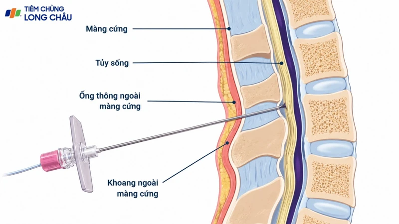 Thuốc được đưa vào khoang ngoài màng cứng qua catheter đặt ở vùng lưng