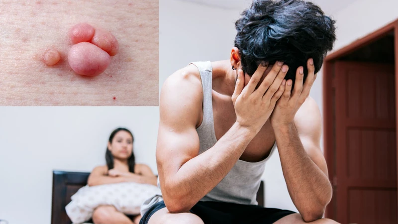Quan hệ bằng miệng có bị lây sùi mào gà không? Lời giải đáp từ chuyên gia y tế 1