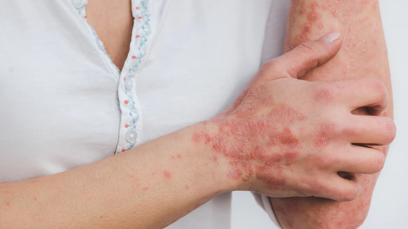 Quan hệ với nhiều người có bị HIV không? Những điều cần biết để bảo vệ bản thân 3