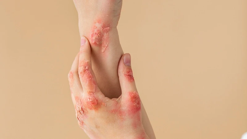 Một số bệnh lý khác như lupus hoặc nhiễm trùng khác có thể gây nhiễu, dẫn đến dương tính HIV giả