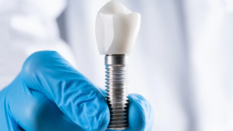 Trong một số tình huống đặc biệt, bác sĩ có thể cân nhắc đặt trụ implant ngay sau khi nhổ răng