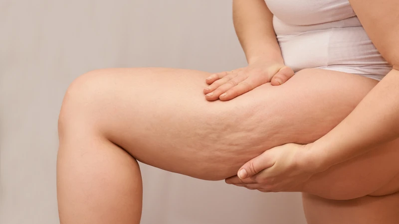 Phương pháp tái tạo bề mặt da bằng laser phân đoạn giúp loại bỏ vết rạn da đùi