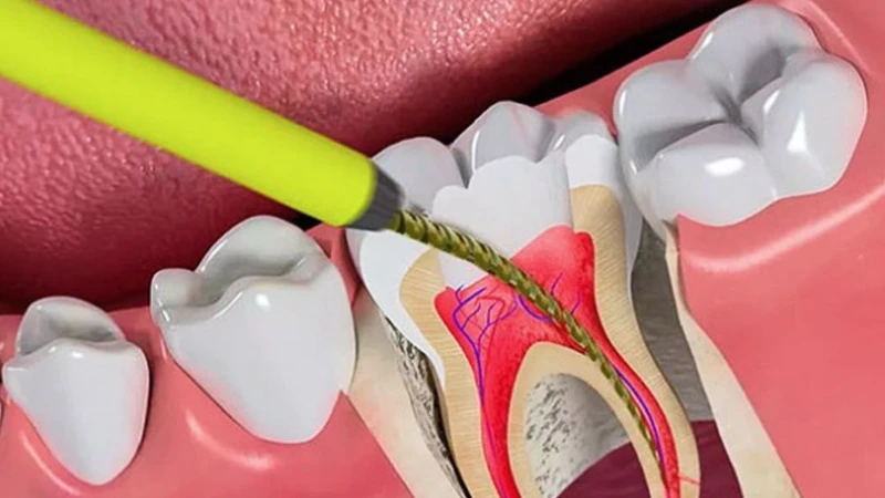 Răng đã lấy tủy là tình trạng tủy răng bị loại bỏ hoàn toàn