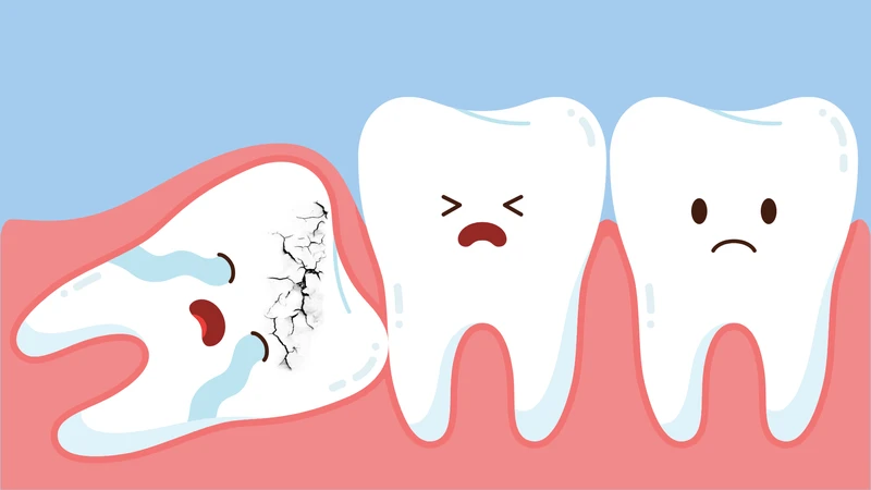 Răng khôn dễ bị sâu hơn so với các răng khác vì răng khôn nằm ở vị trí khó vệ sinh