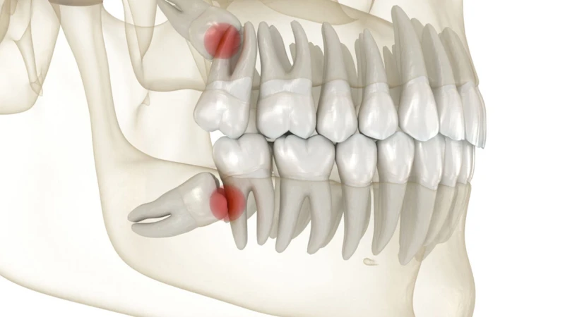 Răng khôn mọc lệch là răng khôn bất thường cần được theo dõi