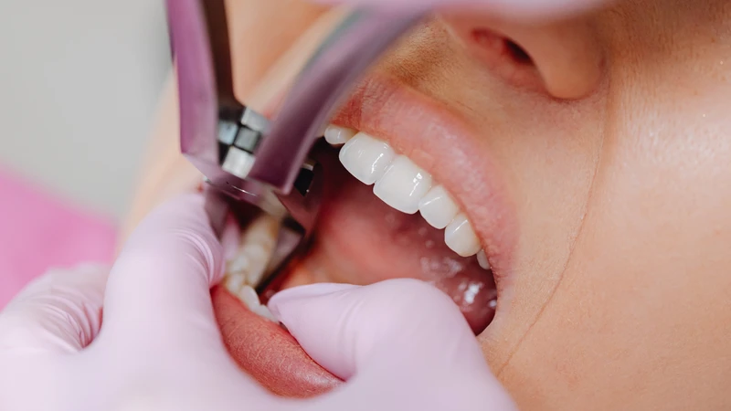 Trong một số tình huống cụ thể, nhổ răng khôn mọc lệch 45 độ là giải pháp cần thiết để ngăn ngừa các biến chứng nặng hơn