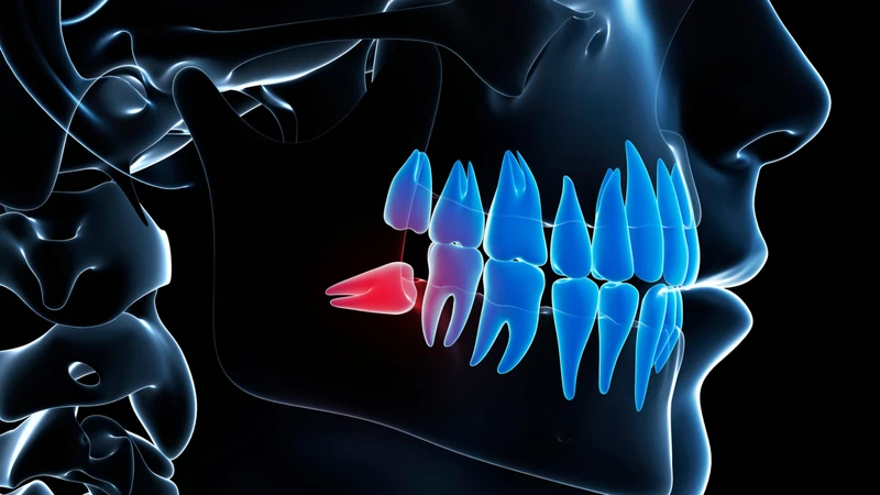 Nhổ răng đúng thời điểm giúp hạn chế biến chứng và bảo vệ răng số 7