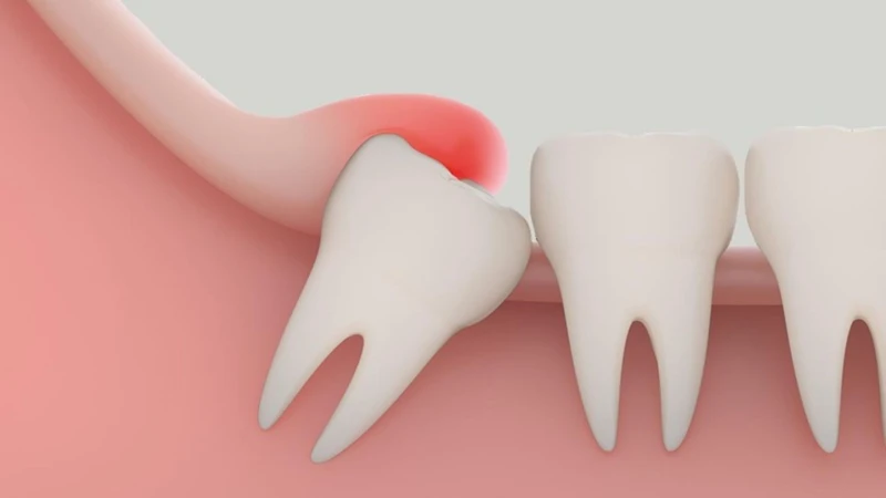 Có không ít độc giả đã và đang phải đối diện với tình trạng răng khôn mọc ngầm