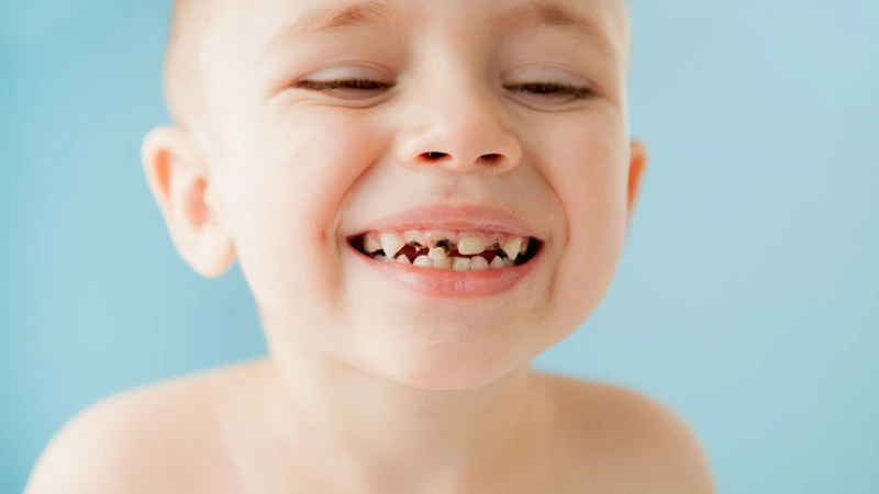 Răng mọc lẫy ở trẻ là gì? Dấu hiệu và cách xử lý 3