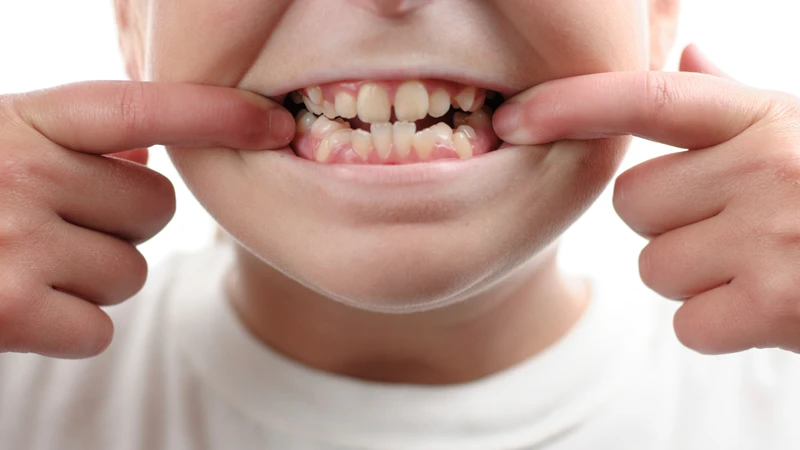 Răng mọc lệch ở trẻ em 1