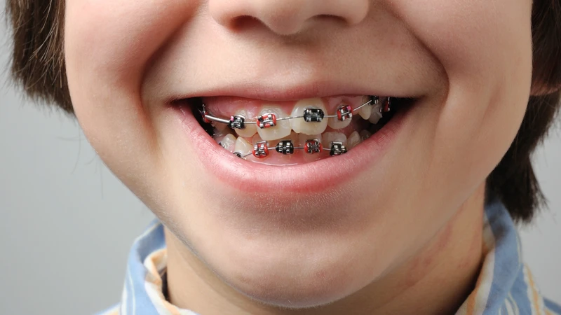 Răng mọc lệch ở trẻ em 4