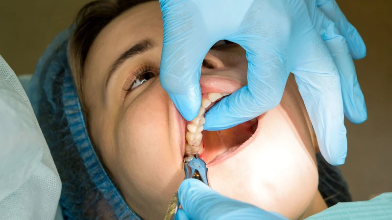 Răng mọc ngầm có nguy hiểm không? Cách xử lý 4