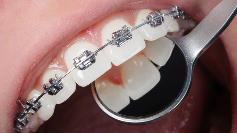 Răng mọc ngược có nguy hiểm không? Cách xử lý 5