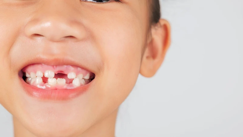 Răng vĩnh viễn mọc khi răng sữa chưa rụng là do chân răng sữa tiêu chậm